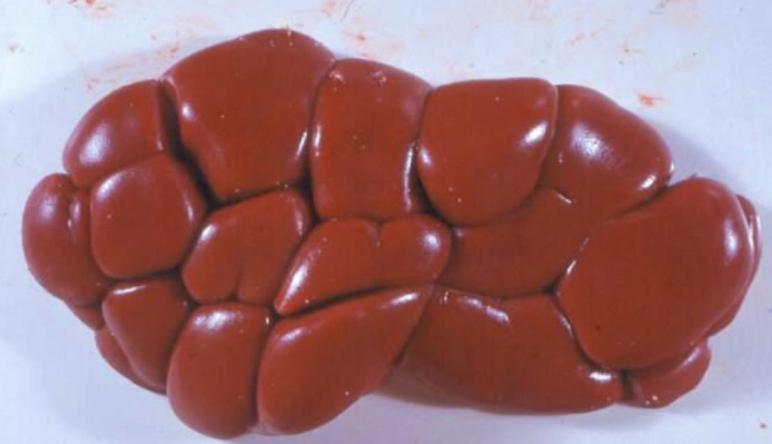 <p>What disease does this kidney have?</p>