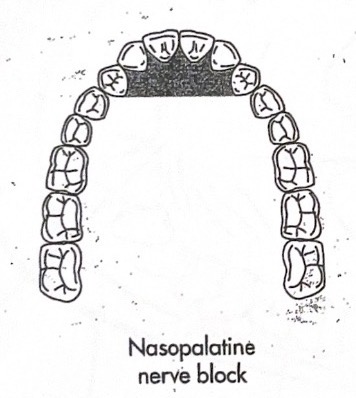 <p>Nasopalatine (NP)</p>