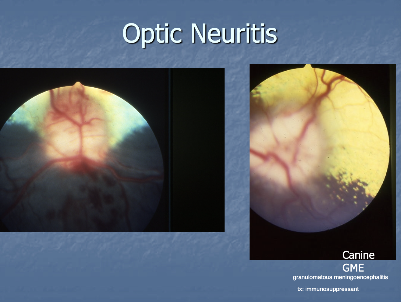 <p>inflammation of optic disc with decreased vision. </p>