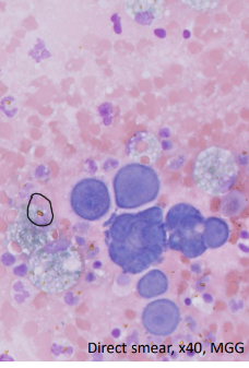 <ul><li><p>Serosanguinous to red</p></li><li><p>RBC / HCT similar or slightly less than peripheral blood</p></li><li><p>TP similar / slightly less than peripheral blood</p></li><li><p>Blood (± platelets); macrophages + erythrophagia and/or HGB breakdown products (circled) ; variable numbers of mesothelial cells</p></li></ul><p></p>