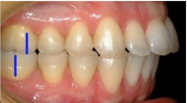 <p>Maxillary incisors are protrusive are procumnent (proclined)</p>