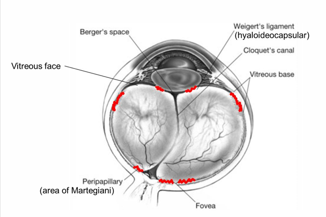 <ol><li><p>vitreous base (spanning the ora serrata)</p></li><li><p>hyaloid capsular aka retrolental ligament of Weigert (posterior lens in the midperiphery)</p></li><li><p>area of martigiani (around optic nerve)</p></li><li><p>at the fovea</p></li></ol><p></p>