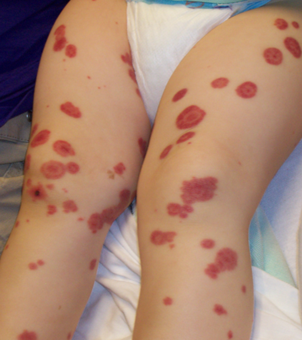 <ul><li><p><span style="font-family: "Avenir Next LT Pro";">Most children present following URI</span></p></li><li><p><span style="font-family: "Avenir Next LT Pro";">Symmetrical purpuric papules and plaques on lower extremities</span></p></li><li><p><span style="font-family: "Avenir Next LT Pro";">GI symptoms follow</span></p><ul><li><p><span style="font-family: "Avenir Next LT Pro";">Nausea, vomiting, abdominal cramping/pain, hematochezia</span></p></li></ul></li><li><p><span style="font-family: "Avenir Next LT Pro";">>60% have arthralgia and more rarely joint swelling, scalp and scrotal edema</span></p></li><li><p><span style="font-family: "Avenir Next LT Pro";">Headache, irritability</span></p></li></ul><p></p>