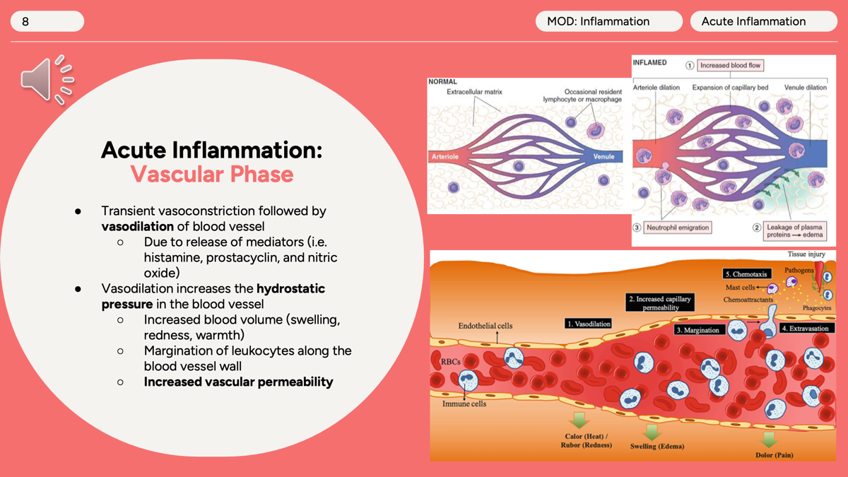 <p>The <strong>vascular phase</strong> is the first stage of acute inflammation and involves changes in blood vessels.</p><ol><li><p><strong>Brief vasoconstriction</strong> occurs immediately after injury.</p></li><li><p><strong>Vasodilation</strong> follows, caused by <strong>histamine, prostacyclin, and nitric oxide</strong>, increasing blood flow to the area.</p></li><li><p>Increased blood flow raises <strong>hydrostatic pressure</strong>, causing <strong>redness (rubor)</strong> and <strong>heat (calor)</strong>.</p></li><li><p>Blood vessels become more <strong>permeable (leaky)</strong>, allowing fluid and proteins to enter tissues.</p></li><li><p>This leakage causes <strong>edema (swelling/tumor)</strong>.</p></li><li><p>As fluid leaves the vessels, neutrophils move toward the vessel wall (<strong>margination</strong>), preparing for migration into the injured tissue. </p></li></ol><p> </p>