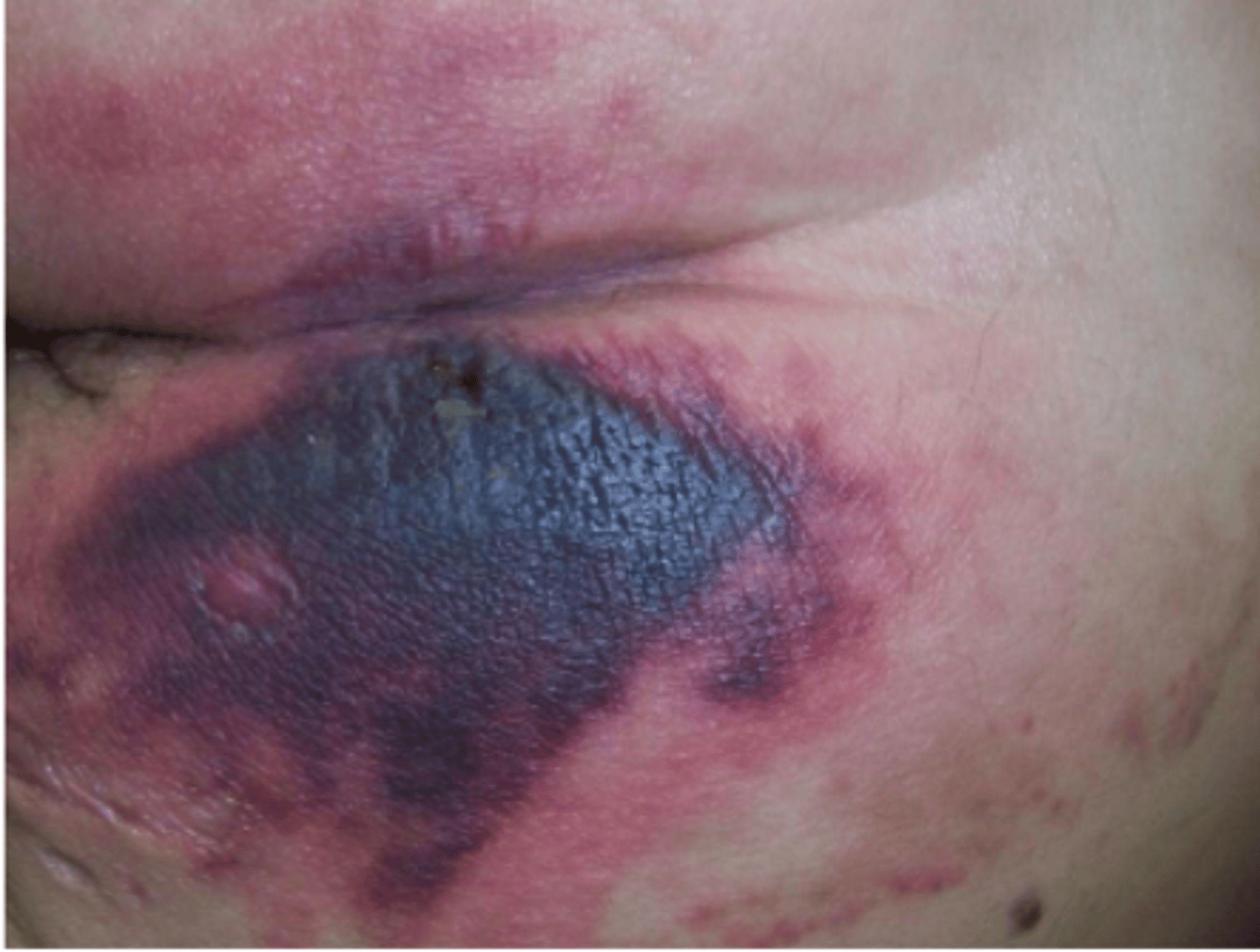 <p>deep red/purple discoloration that is not blanchable, includes blood filled blisters</p>
