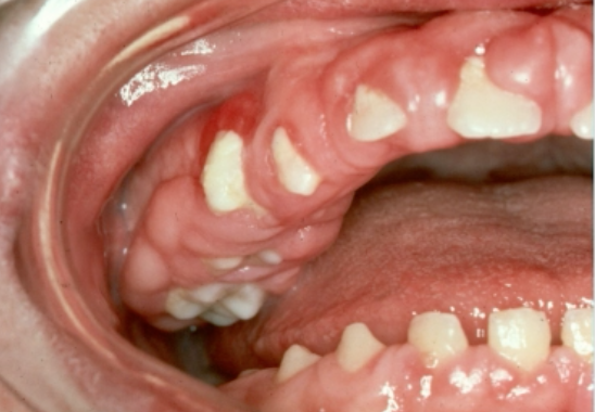 <p>which is NOT in the differential diagnosis </p><p>leukemic gingival enlargemnt </p><p>drug induced gingival hyperplasia </p><p>autoimmune condition </p><p>hereditary gingival fibromatosis </p>