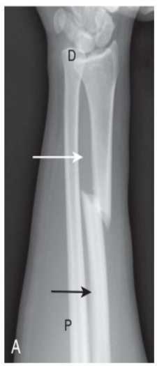 <p>fracture orientation</p>
