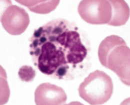 <p>What is the causation and presentations of the Chediak Higashi syndrome?</p>