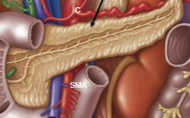 <p>Recieves blood from celiac (splenic artery) and superior mesentaric. Completley <strong>retroperitoneal</strong>. Secretes digestive enzymes (amylase, lipase and proteinase) from acinar cells and bicarbonate buffer from centroacinar cells. These all combine into the central pancreatic duct, which moves from the tail towards the head of the organ. It combines with the bile duct, and then can move into the duodenum through the hepatopancreatic sphincter.</p>