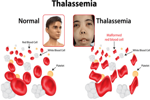 <p>Autosomal recessive: Improper hemoglobin production; symptoms range from mild to severe</p>