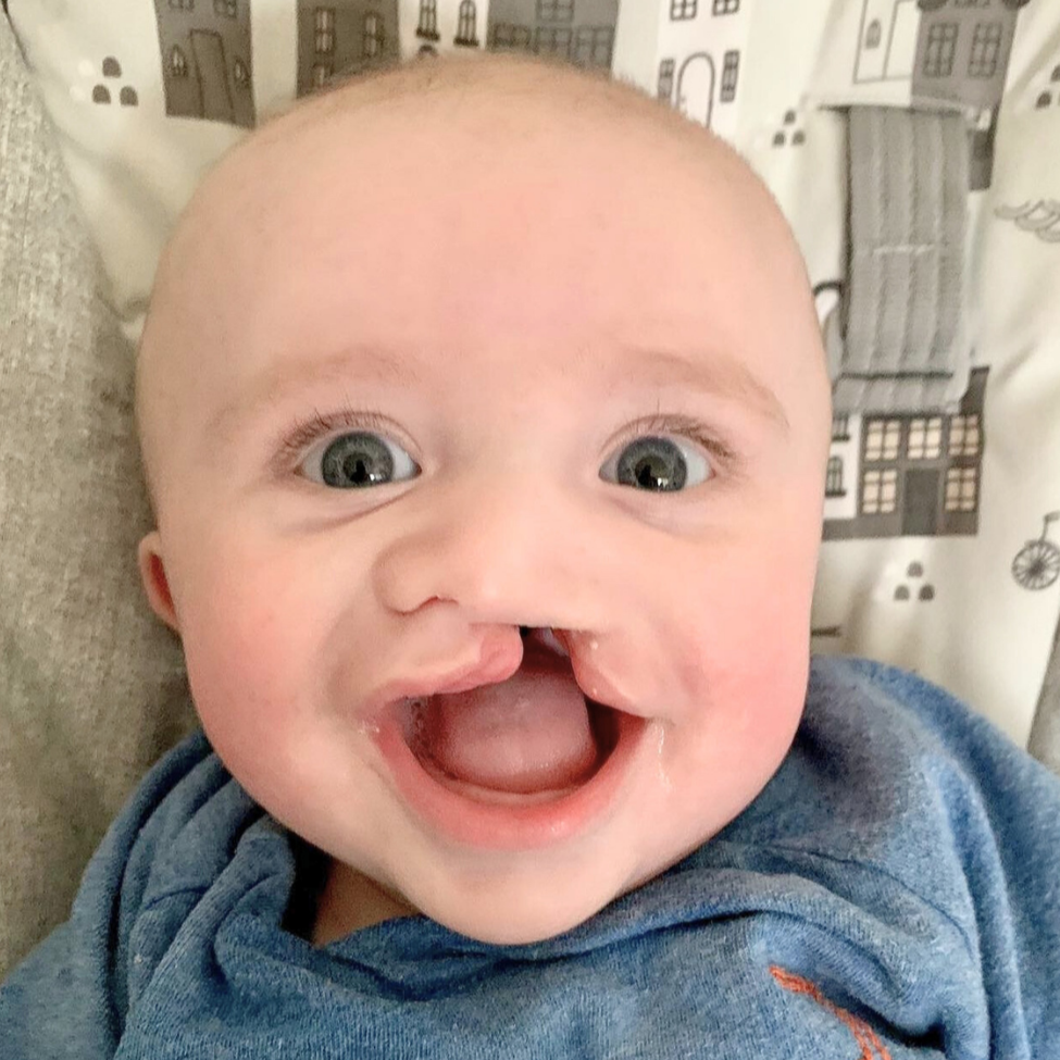 <p>fetal abnormality; abnormal process during gestation or birth (ex: cleft lip)</p>