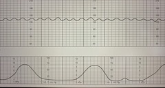 <p>- rare but ominous</p><p>- high rate of fetal morbidity and mortality</p><p>- smooth sine wave that occurs 2-5 cycles per minute</p><p>- amplitude of 5-15bpm</p><p>- indicates severe fetal anemia</p>