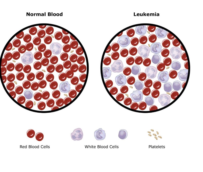 <p>leukemia</p>
