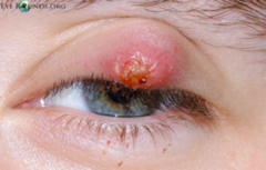 <p>Chronic granulomatous inflammation</p><p>Painless nodule within the eyelid</p><p>Glucocorticoid injection,</p><p>compresses, surgery</p>