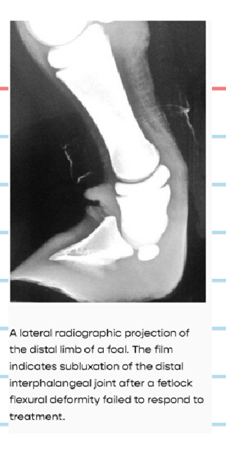 <p>Flexural Deformities (Club foot):D.X</p>