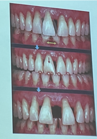 <p><span>¿Qué es la migración dental patológica y dónde se presenta con mayor frecuencia?</span></p>