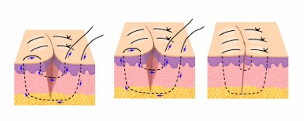 <p>-good for everting wound edges and areas with high tension (over joints, chest, back)</p>