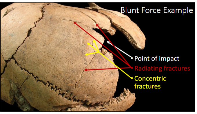<p>slow velocity application of stress over relatively large surface area</p><p>fractures follow path of least resistance</p><p>ex: club, hammer, fists, falls</p>