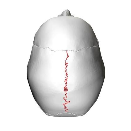 <p>A dense, fibrous joint running down the middle of the top of the skull that connects the left and right parietal bones</p>