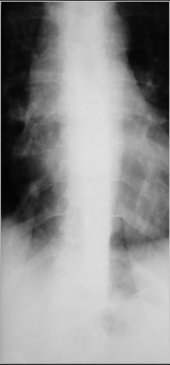 <p>Is this film of diagnostic quality (AP Thoracic)</p>