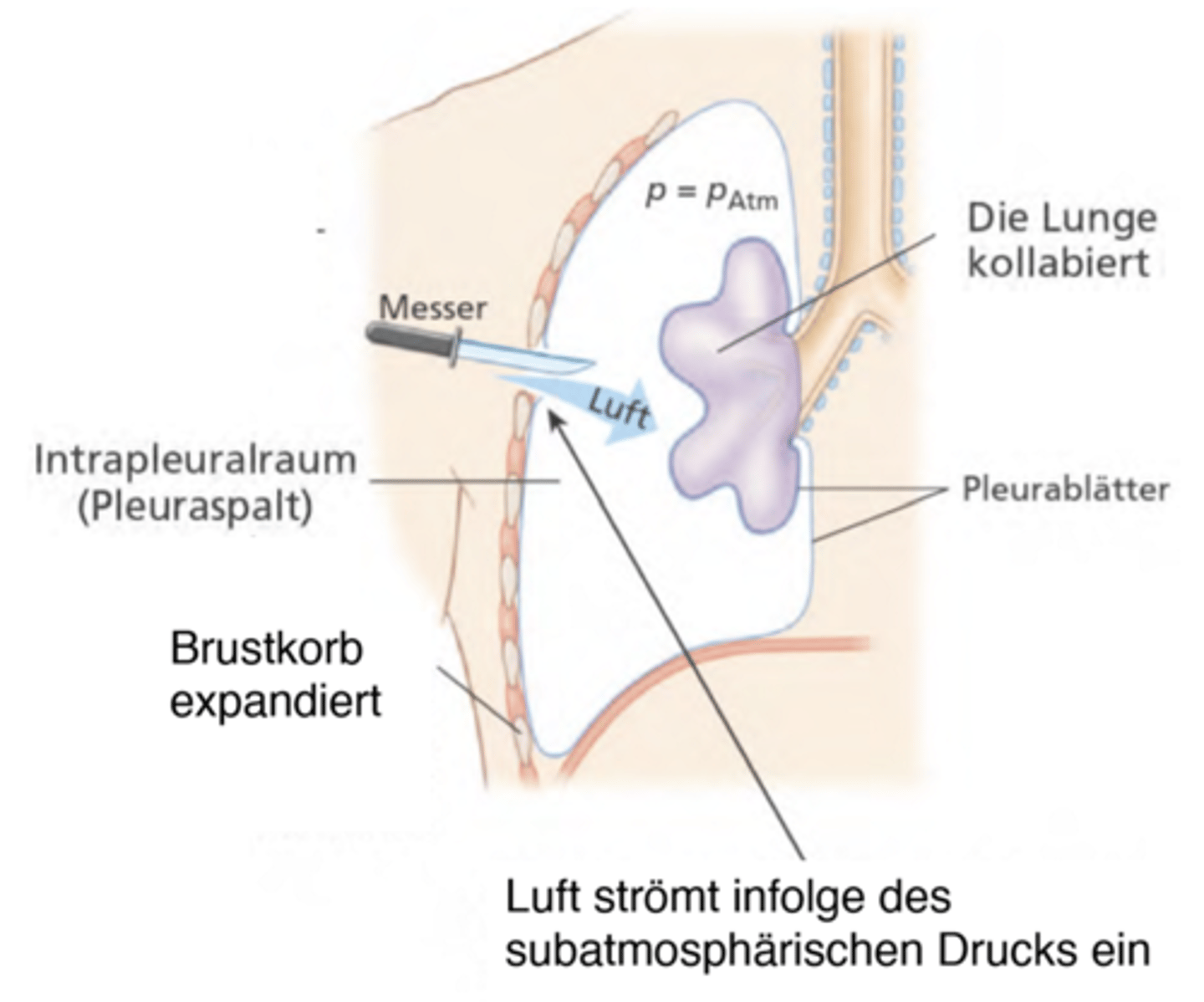 <p>Die Pleurahöhle ist geöffnet (sollte sie nicht sein), dh Luft dringt in Pleurahöhle ein was zu einem Lungenkollaps führt.</p><p>(Behandlung: Luft muss abgesogen & Öffnung geschlossen werden)</p>