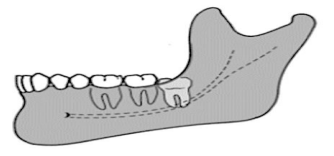 <p><span style="color: red;">½ </span>of the mesiodistal diameter of the crown<span style="color: red;"> </span>is <span style="color: red;">covered with the ramus</span></p>