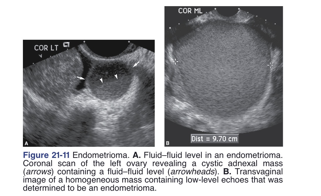 <p>Predominantly cystic mass with low-level internal echoes (may resemble a hemorrhagic cyst)</p><p>Anechoic or complex mostly cystic mass with posterior enhancement and may contain a fluid–fluid level</p>