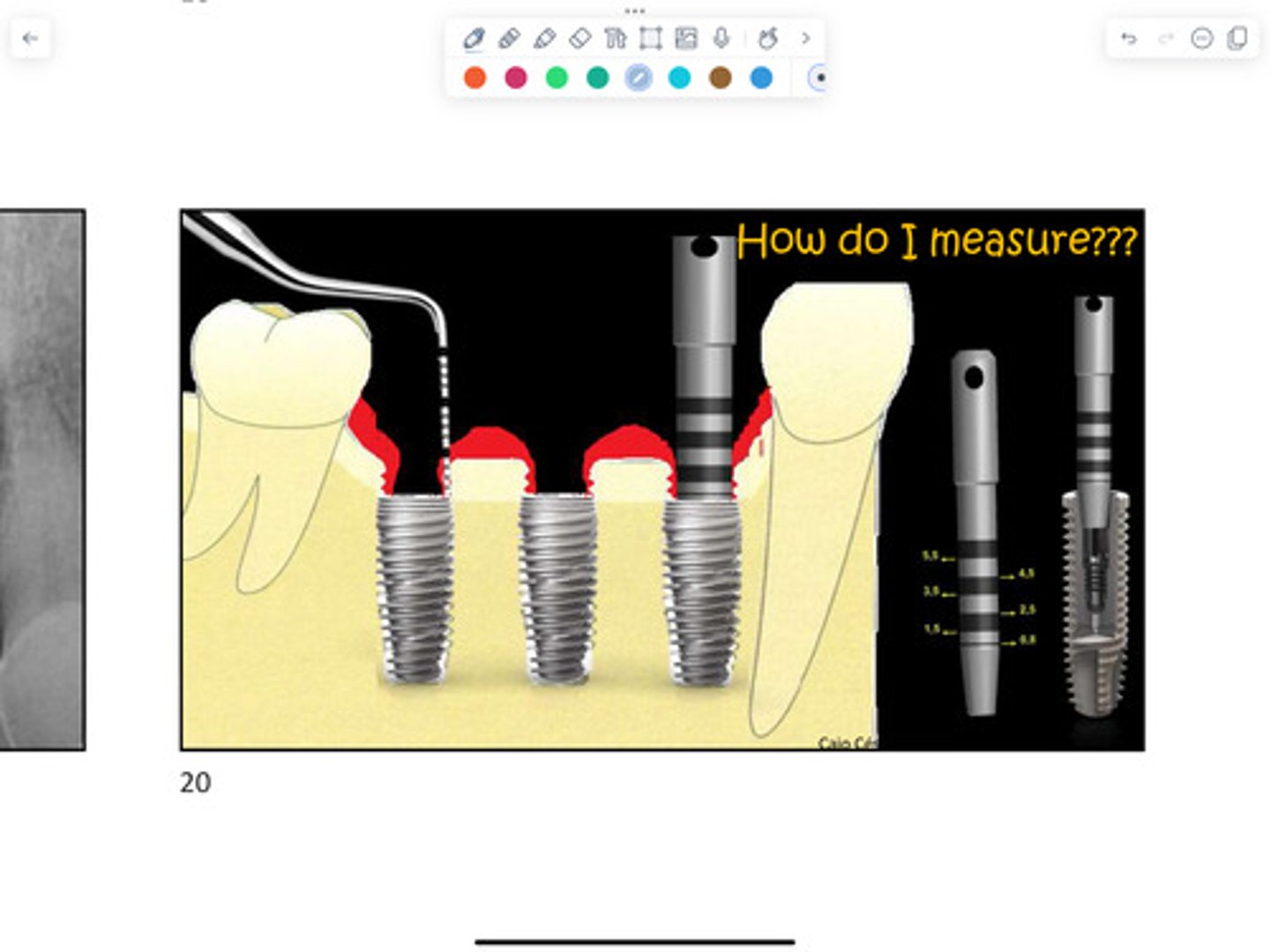<p>What size abutment should be selected for from this picture?</p>