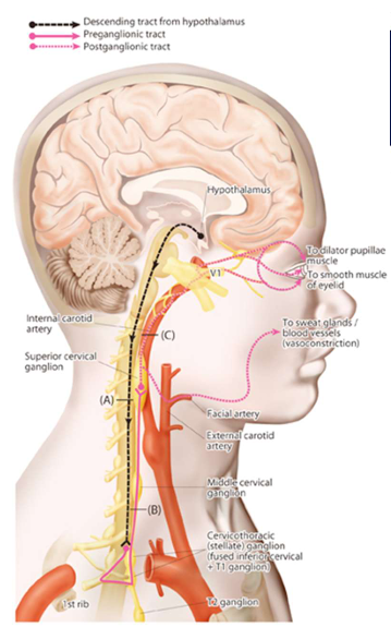 <p>This is the pathway for:<br><strong>Arousal/fight-or-flight/darkness → pupil dilates.</strong></p><p></p><p><strong>Hypothalamus </strong>→ Sympathetic preganglionic neurons in intermediolateral column (<strong>T1-T2 spinal cord</strong>)</p><p>Preganglionic Fibres: <strong>Exit via T1-T2 spinal nerves</strong> → <strong>Superior cervical ganglion</strong> (in neck)</p><p>Postganglionic Fibres: Travel along <strong>internal carotid artery</strong> → <strong>Cavernous sinus</strong> → Ophthalmic division of <strong>CN V</strong> → <strong>Long ciliary nerves</strong> → <strong>Dilator pupillae muscle</strong> Pupil dilation</p><p></p><p></p><ul><li><p><em>T1/T2 are near the lung</em></p></li><li><p><em>travel up the neck and synapse</em></p></li></ul><p></p>