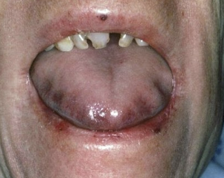 <p>abnormally large tongue </p>