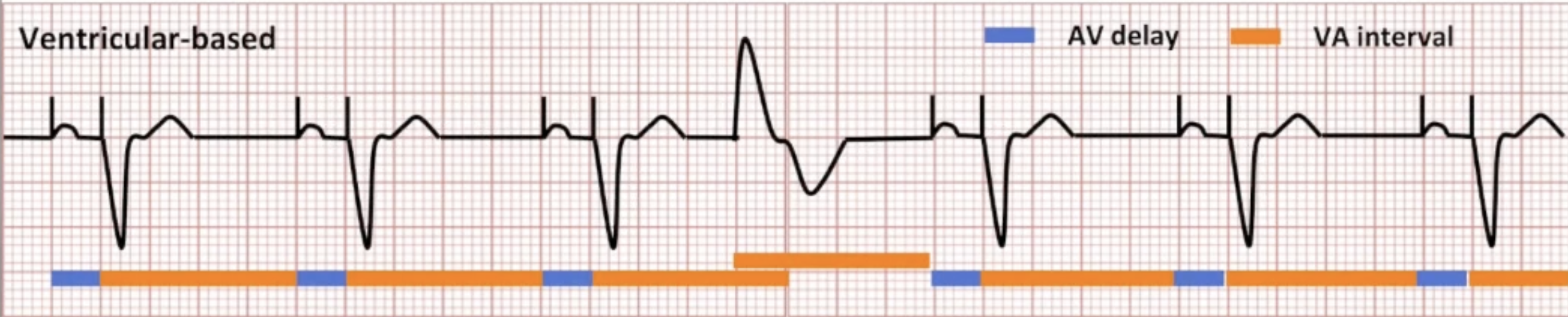 <ul><li><p>PVC defined by the device:</p><ul><li><p>Two consecutive ventricular events</p></li><li><p>No intervening atrial events</p></li><li><p>Second event is VS</p></li></ul></li><li><p>Ventricular-based timing: PVC triggers new VA interval</p></li></ul><p></p>