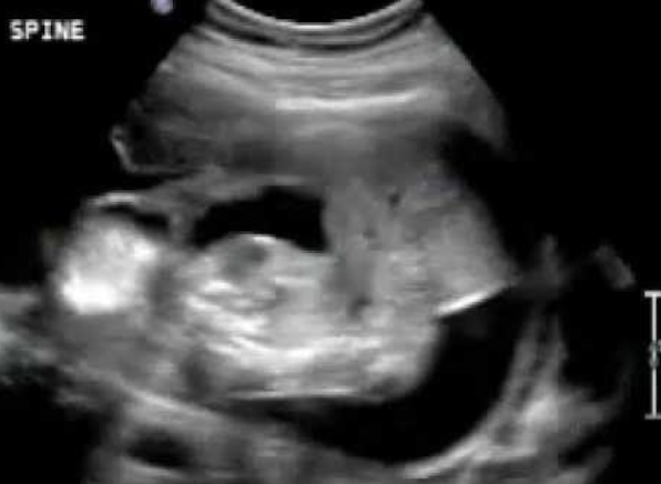 <ul><li><p>large ventral wall defect of abdomen and thorax (usually left-sided)</p></li><li><p>eviscerated organs form a complex mass entangled with membranes</p></li><li><p>cranial anomalies</p></li><li><p>limb defects</p></li><li><p>short umbilical cord</p></li><li><p>fetus is inseparable from placenta (fetus is right on top of it)</p></li></ul><p></p>