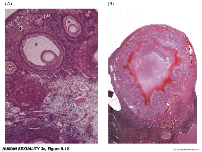 <ul><li><p>Follicle size indicates stage of development (small = early, larger = more mature).</p><ul><li><p>a = antrum</p></li></ul></li><li><p>Monitored using <strong><u>transvaginal ultrasound</u></strong> during fertility testing.</p></li><li><p>Patients may undergo daily ultrasounds and blood tests for ~7–12 days (psychological effects).</p></li><li><p>Image B: Corpus luteum; ruptured follicle</p><ul><li><p>After ovulation, the ruptured follicle forms the corpus luteum.</p></li><li><p>Corpus luteum secretes progesterone, which helps prepare the uterus for implantation.</p></li></ul></li></ul><p></p>