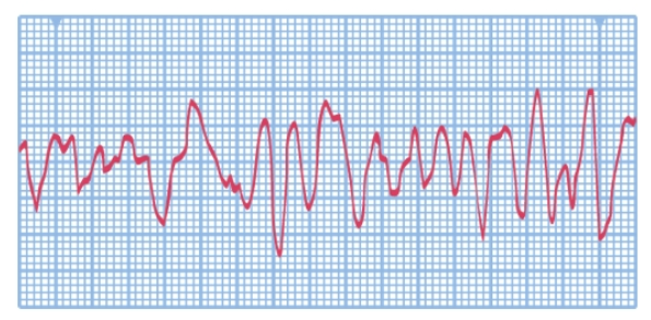 <p>Which rhythm would the nurse document when observing the following dysrhythmia on a client’s cardiac monitor?</p>