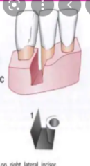 <p>Intrabony defect with 1 bony wall.</p><p>(Explanation: Hemiseptum defects, with only one supporting wall, have limited regenerative potential due to minimal bone support, often requiring grafts or membranes.)</p>