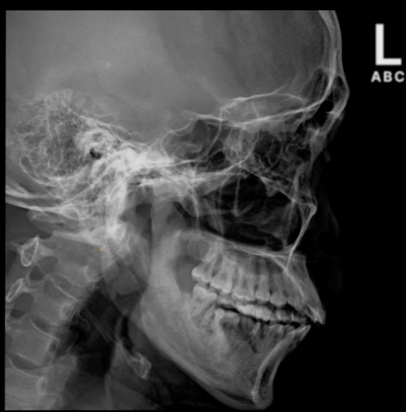 <p>lateral facial bones demonstrates: </p>