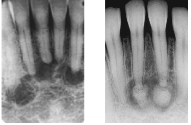 <p>periapical cemento-osseous dysplasia </p>