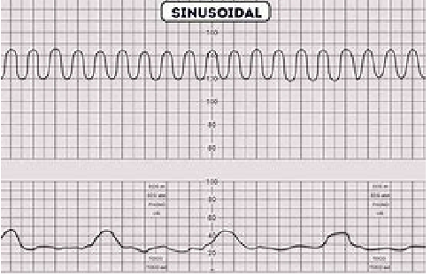 <p>“Abnormal must deliver”<br>sinusoidal pattern<br>absent baseline FHR with recurrent variable or late decelerations, bradycardia</p>