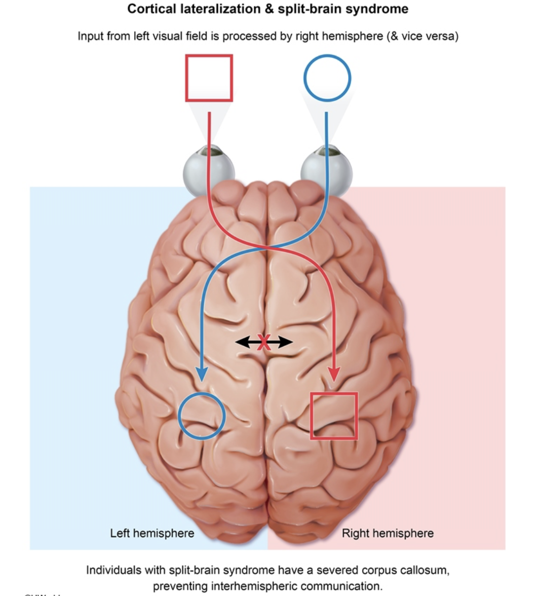 <ul><li><p>severed corpus callosum</p></li><li><p>prevents communication btwn hemispheres</p></li><li><p>individuals experience a disconnect btwn info processed on right and left sides of brain </p></li></ul><p></p>