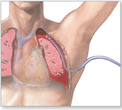 <p>To remove air or fluid from pleural and/or mediastinal space</p><p>Reestablishes negative pressure</p><p>Lung re-expands</p>