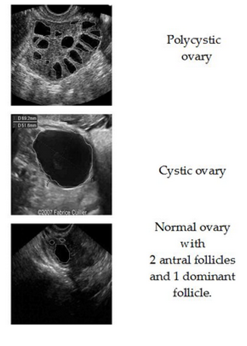 <ul><li><p>Classically, those with PCOS have enlarged ovaries with numerous peripheral small antral follicles and increased central stroma</p></li><li><p>Possible Mechanism: normal follicular growth appears to occur up to the midantral stage, after which maturation ceases</p></li><li><p>As the follicle reaches the midantral stage, the <strong><u>granulosa</u></strong> cell layer becomes progressively degenerative and the entire structure may have the appearance of a thin-walled cyst</p></li><li><p>In contrast, the <strong><em>thecal</em></strong> cell layer that surrounds the follicle becomes substantially hyperplastic and thickened compared to that of normal follicles and is responsible for increased androgen production</p></li></ul><p><em>**Androgen increase in livers AND ovaries = hyperandrogegism is hallmark feature</em></p>