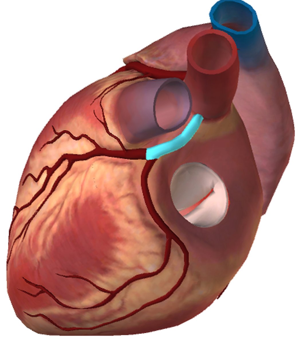 <p>Left coronary artery</p>