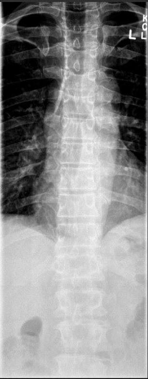 <p>Is this film of diagnostic quality (AP Thoracic)</p>