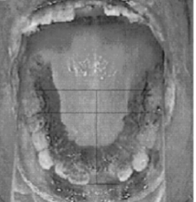 <p>broad contact all along inside the surface of the upper teeth and beyond</p>