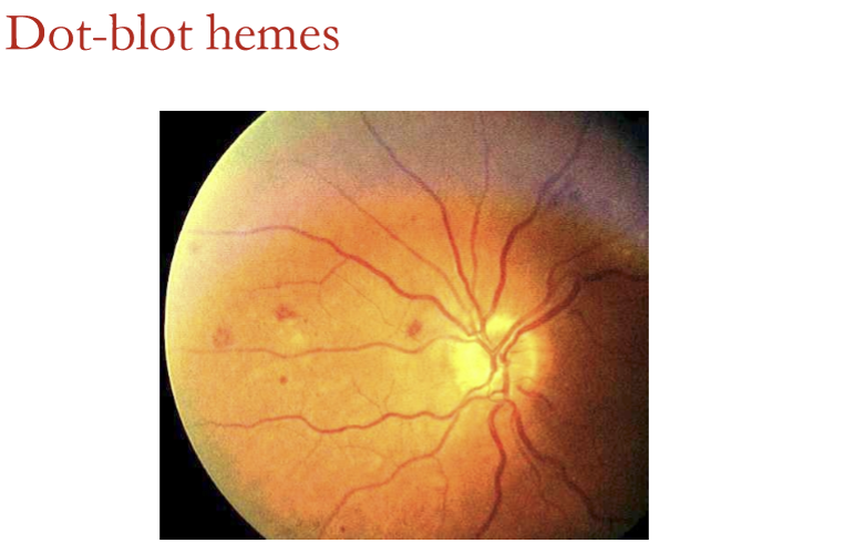 <p>If ALL the following are true:</p><ul><li><p>Fewer than 4 hemorrhages</p></li><li><p>Peripheral location</p></li><li><p>Small (≈ diameter of a retinal vessel)</p></li><li><p>Patient > 50 years old<br>Then the hemorrhages may reflect benign peripheral retinal vascular degeneration, and some clinicians may choose not to refer.</p></li></ul><p></p>