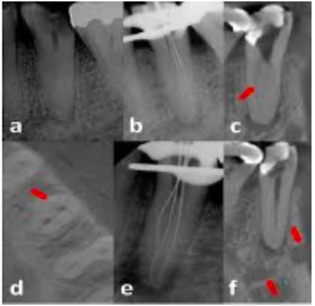 <p><span style="color: red;"><span>sudden disappearance</span></span><span> of the canal along its length</span></p><p><strong><span>signifies:</span></strong><span style="color: red;"><strong><span> </span></strong></span></p><ul><li><p><span style="color: red;"><span>splitting </span></span>of the canals</p></li><li><p><span>presence of a </span><span style="color: red;"><span>bifurcation / trifurcation</span></span></p></li></ul><p></p>