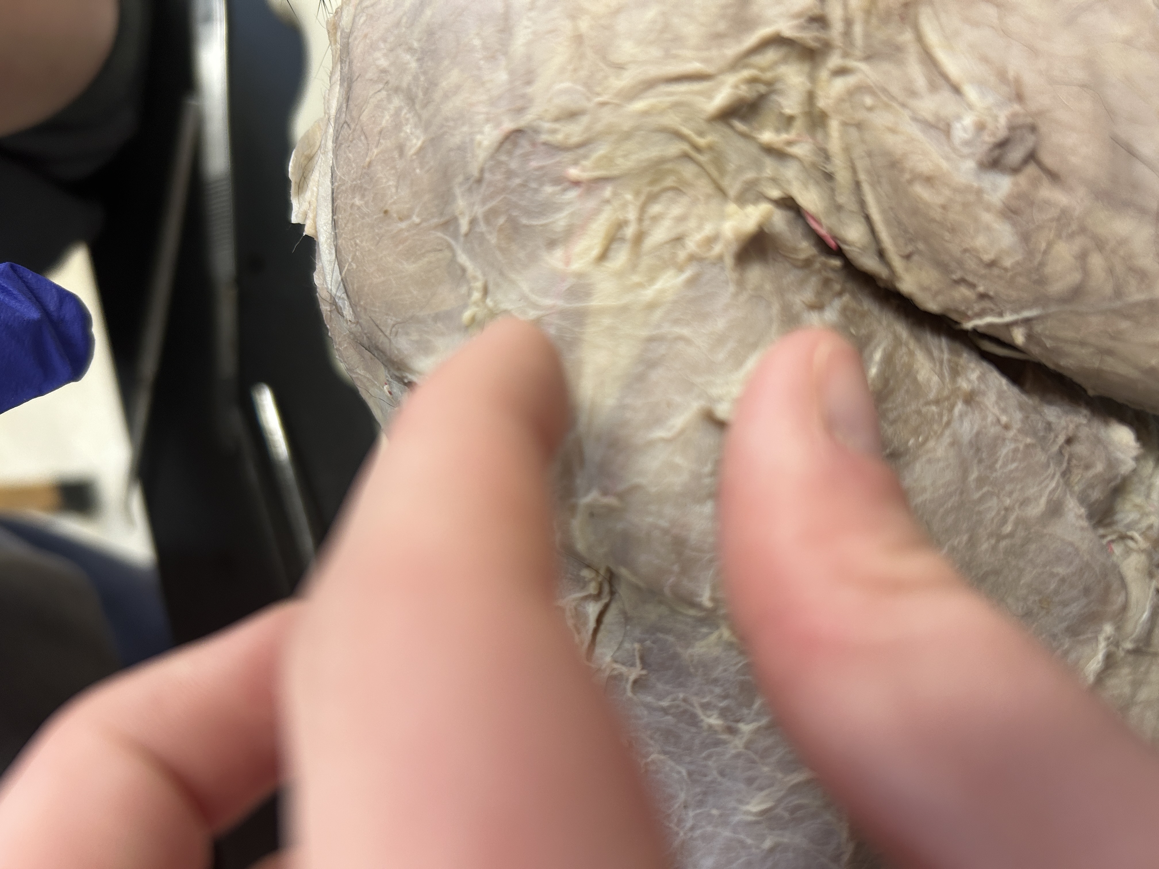 <p>Spinodeltoid(little section under armpit area)</p>