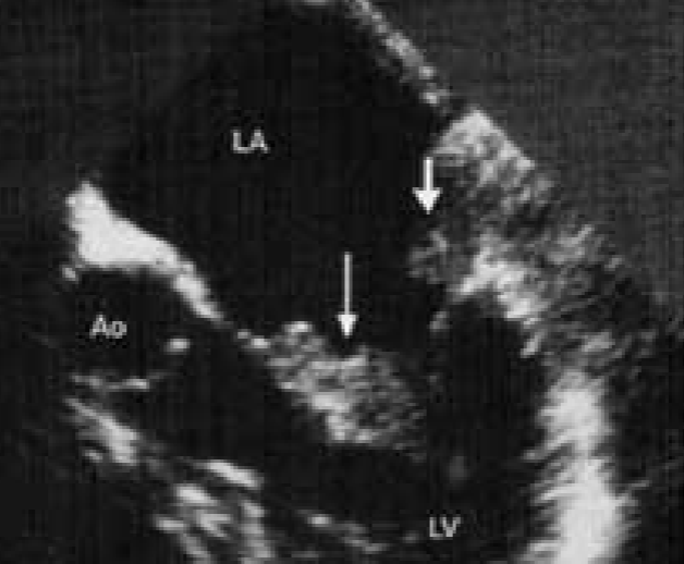 <ul><li><p><span style="color: rgb(0, 147, 255);">RA</span> l<strong>ocation 80%</strong></p></li><li><p><span style="color: red;">most common primary malignant tumor of the heart</span></p></li><li><p>may cause <u>inflow obstruction</u></p></li><li><p>associated w/ pericardial effusion</p></li></ul><p></p>