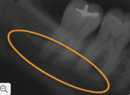 <p>submandibular fossa</p>