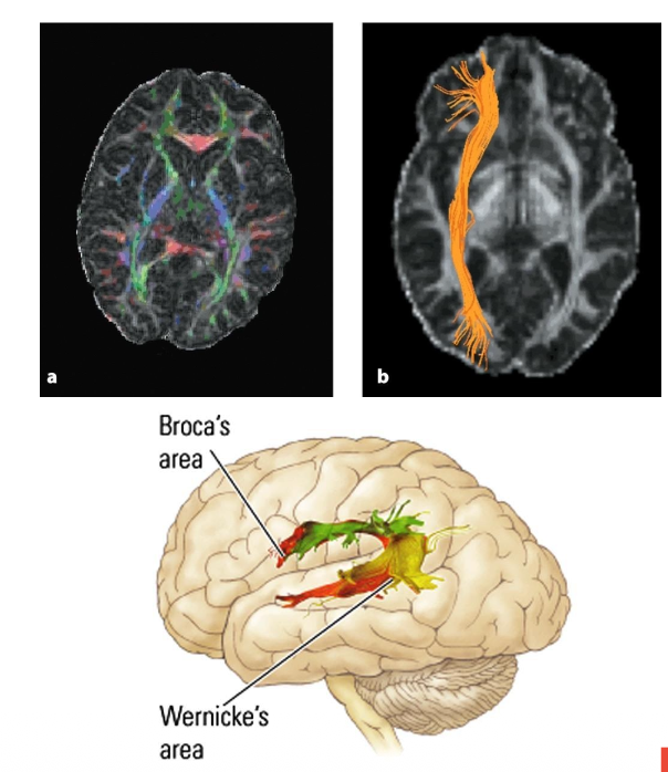 <ul><li><p>MRI method that <strong><mark data-color="purple" style="background-color: purple; color: inherit;">images fiber pathways by detecting directional movements of water molecules in ventricles</mark></strong></p></li><li><p class="p1"><strong>Movement</strong> in<strong><mark data-color="purple" style="background-color: purple; color: inherit;"> nerve fibers tends to follow the longitudinal axis, a property called anisotropy</mark></strong></p></li><li><p class="p1">Can <strong><mark data-color="purple" style="background-color: purple; color: inherit;">detect degeneration of axons & distortion of and damage to fibers</mark></strong></p></li><li><p class="p1">Can be <strong>combined</strong> with <strong><mark data-color="purple" style="background-color: purple; color: inherit;">MRI, fMRI, & ERP</mark></strong></p></li></ul><p></p>